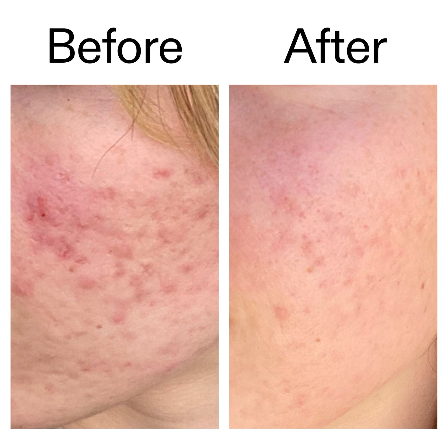 10-azelaic-acid-serum-for-redness-relief-c6 Azealic_Acid_Serum_B_A_Ppage_2000_x_2000.jpg