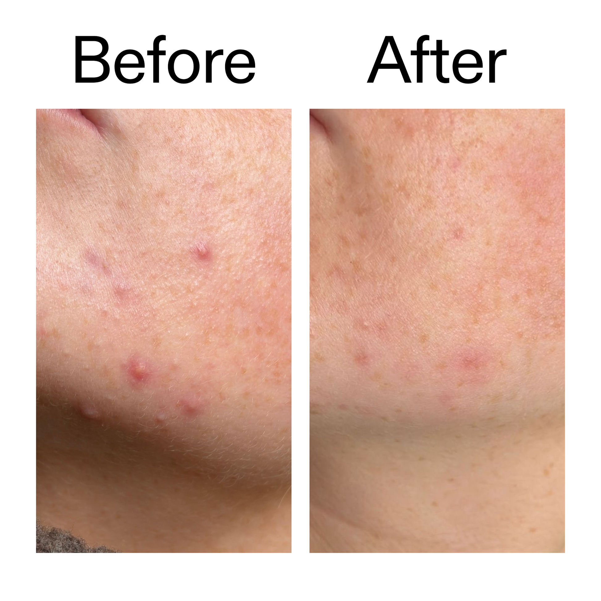 10-azelaic-acid-serum-for-redness-relief-c6 B_A_1_PPAGE.png