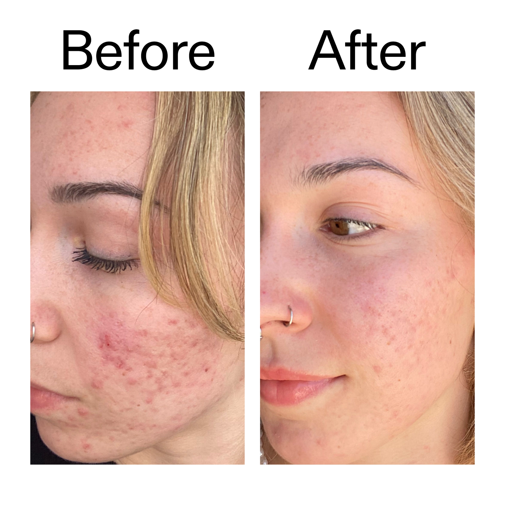 10-azelaic-acid-serum-for-redness-relief-c6 B_A_2_PPAGE.png