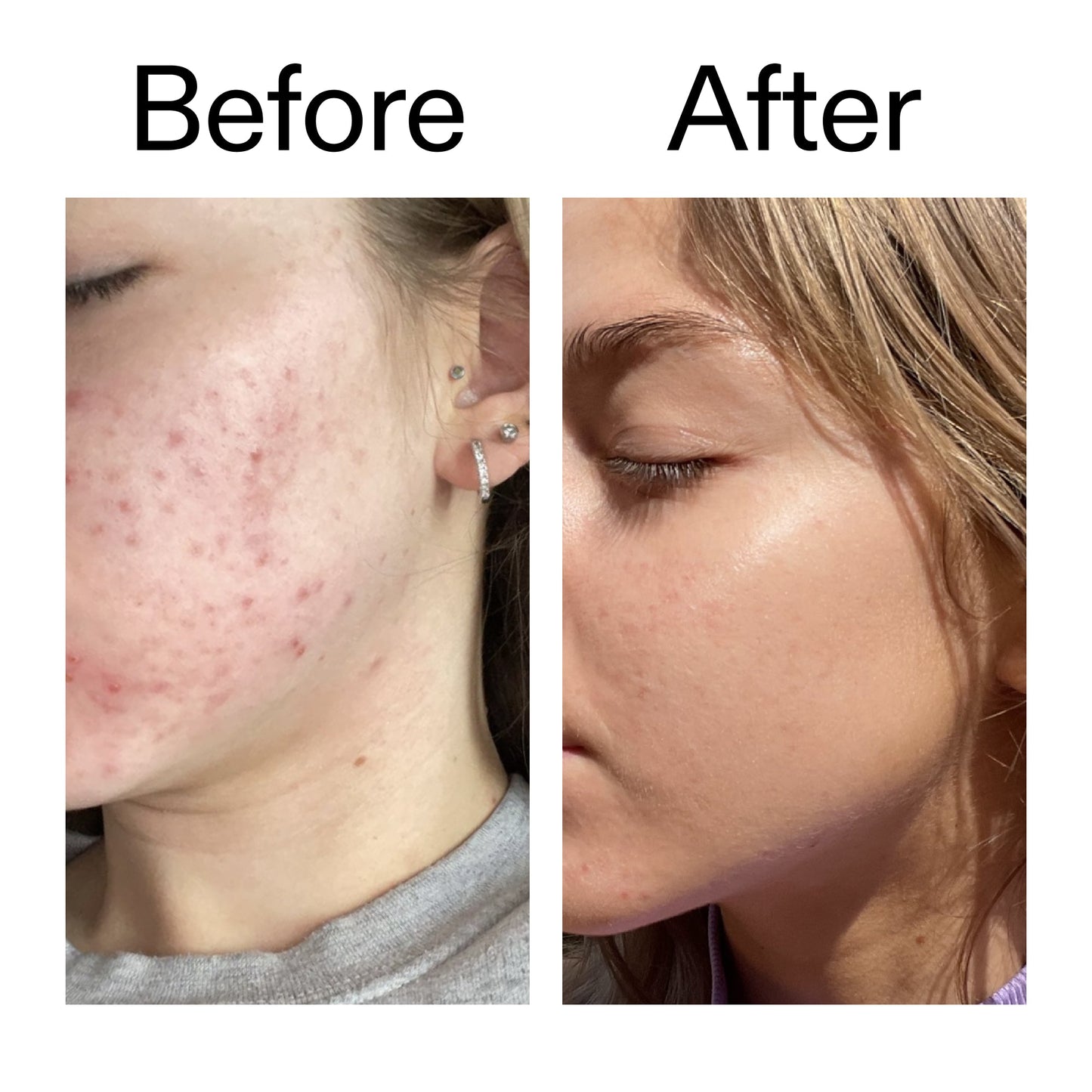 beta-hydroxy-acid-bha-serum-s0 Beta_Hydroxy_Acid_Serum_Before_After_2000x2000_96fda3e5-938d-49ef-bcf2-a0fa6ece4e2c.jpg