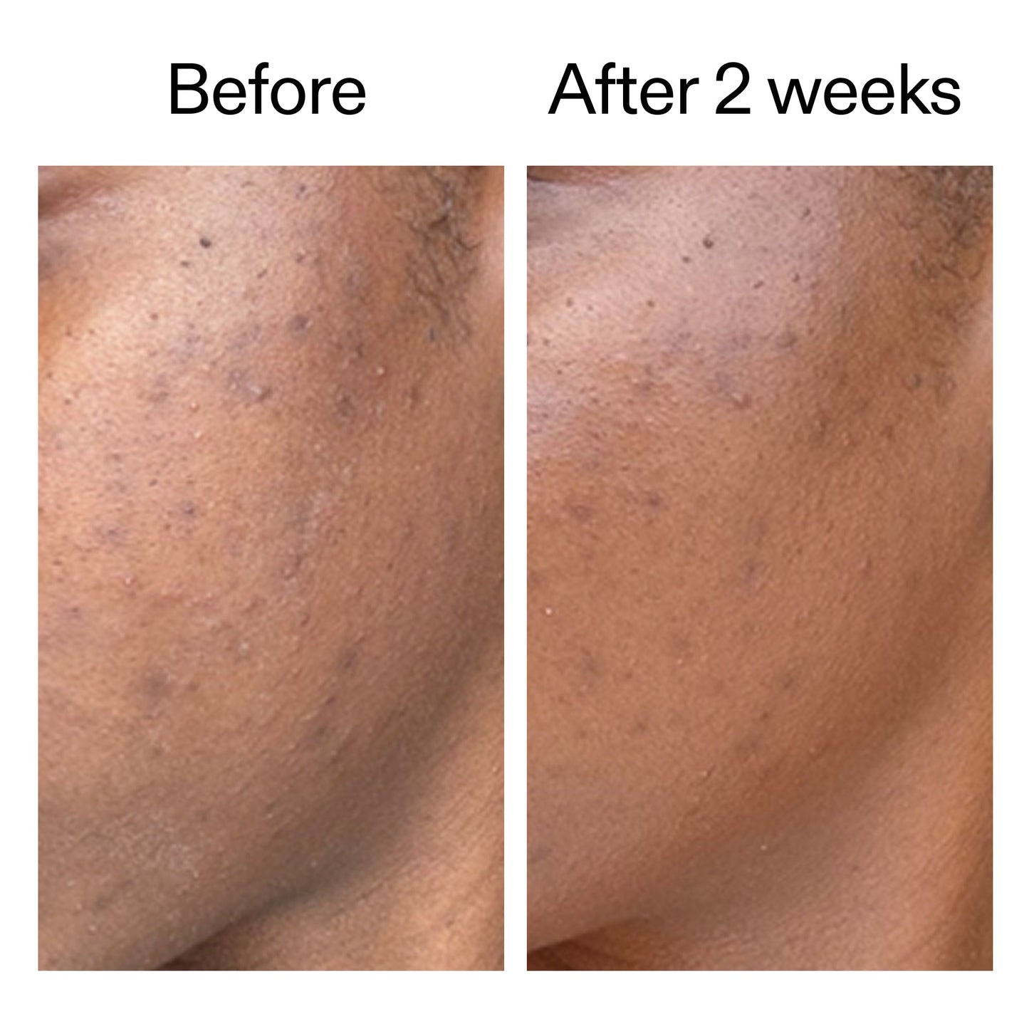360-acne-clearing-serum-x1 DIOICB_A2000x2000.jpg