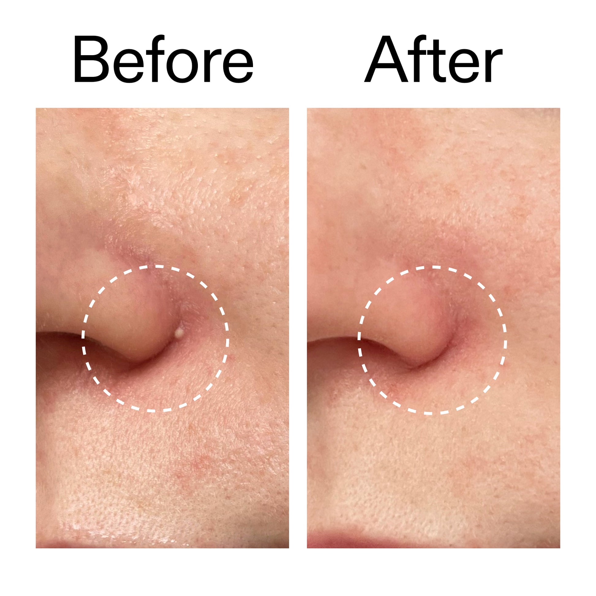 hydrocolloid-invisible-pimple-patches-pack-of-44-o1 Hydrocolloid_Invisible_Pimple_Patches_Before_After_2000x2000_b02aa37b-c78a-4682-91de-9135af5bb7df.jpg
