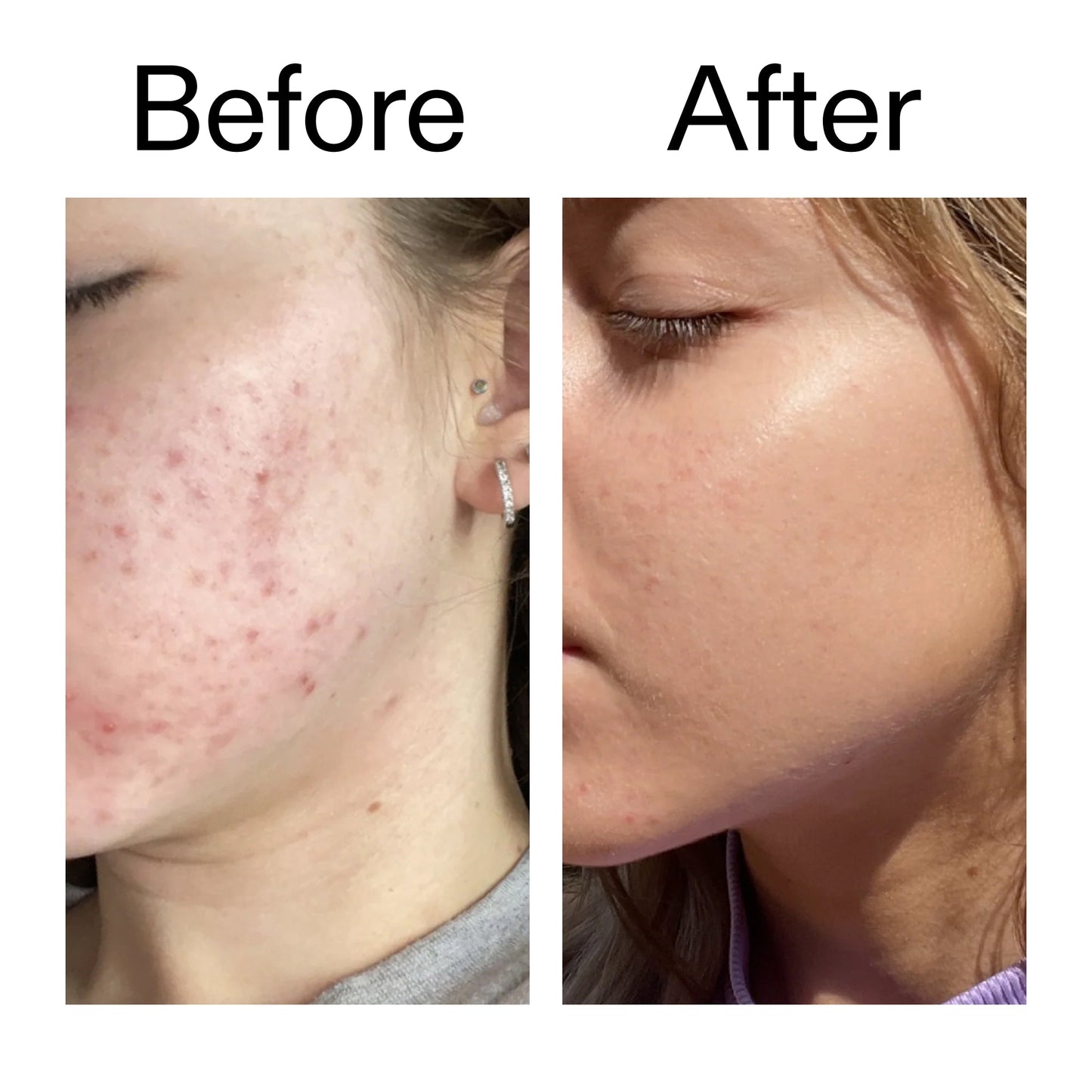 10-niacinamide-serum-duo-h1 Niacinamide_Serum_Before_After_2000x2000_bde32455-9e7d-448e-b053-bef41504f0a9.jpg