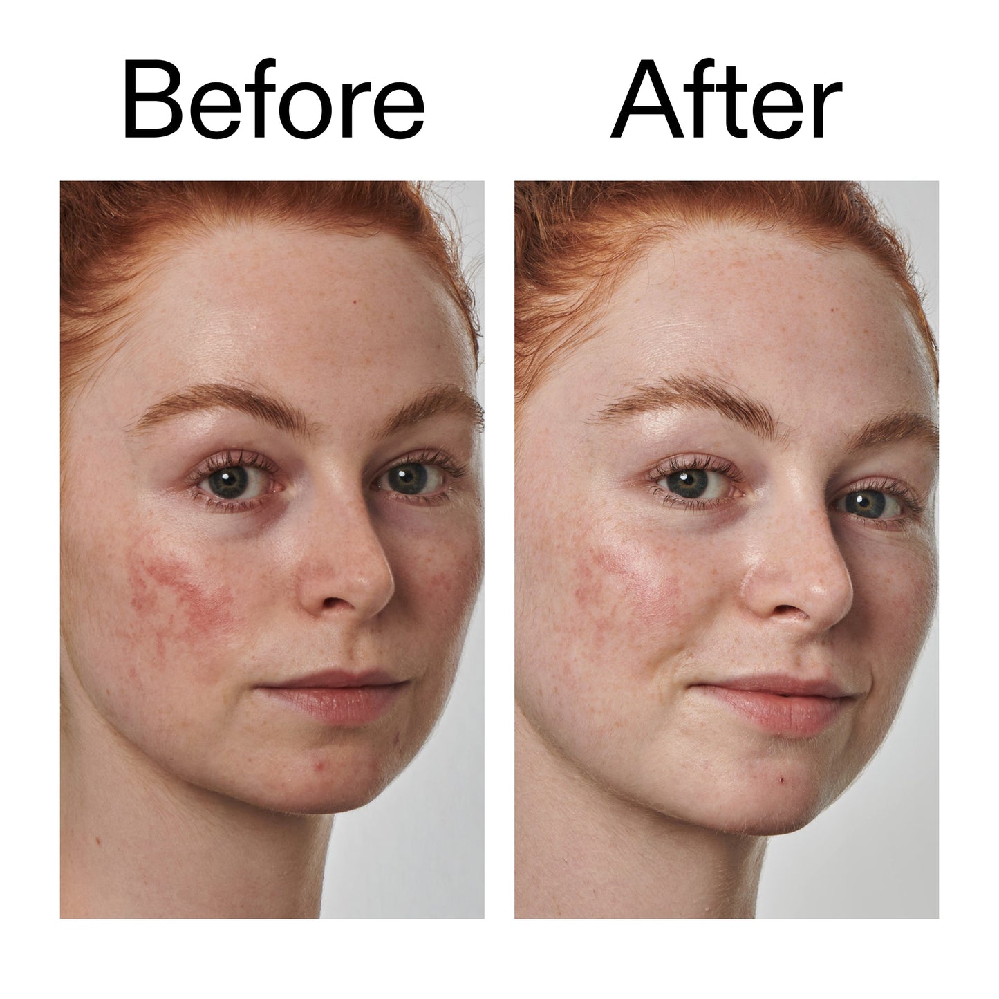 10-azelaic-acid-serum-for-redness-relief-c6 Redness_Relief_Serum_Before_After_2000x2000_3334dc9a-cce9-4e00-8aec-7ad89ca051f2.jpg
