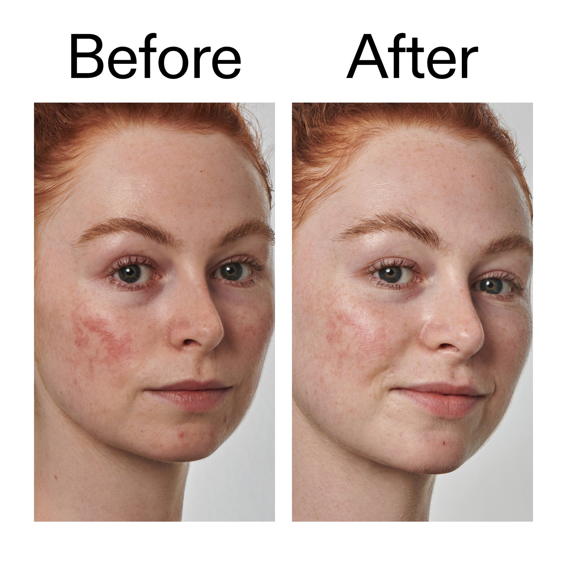 10-azelaic-acid-serum-for-redness-relief-c6 Redness_Relief_Serum_Before_After_2000x2000_3334dc9a-cce9-4e00-8aec-7ad89ca051f2.jpg